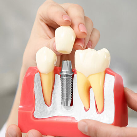 dental implant in Westminster