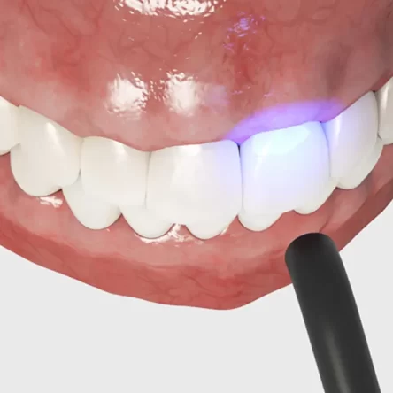 Can You Whiten Teeth After Dental Bonding? Expert Advice